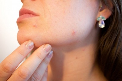Sarah Dale Aesthetics blog image - What does Stress do to our Skin?