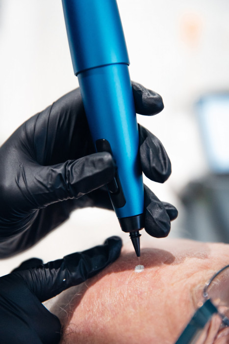 Image 1 from CryoPen | Sarah Dale Aesthetics