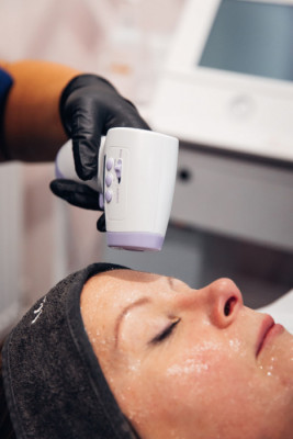 Image 1 from Freeze &ndash; Non-Surgical facelift  | Sarah Dale Aesthetics