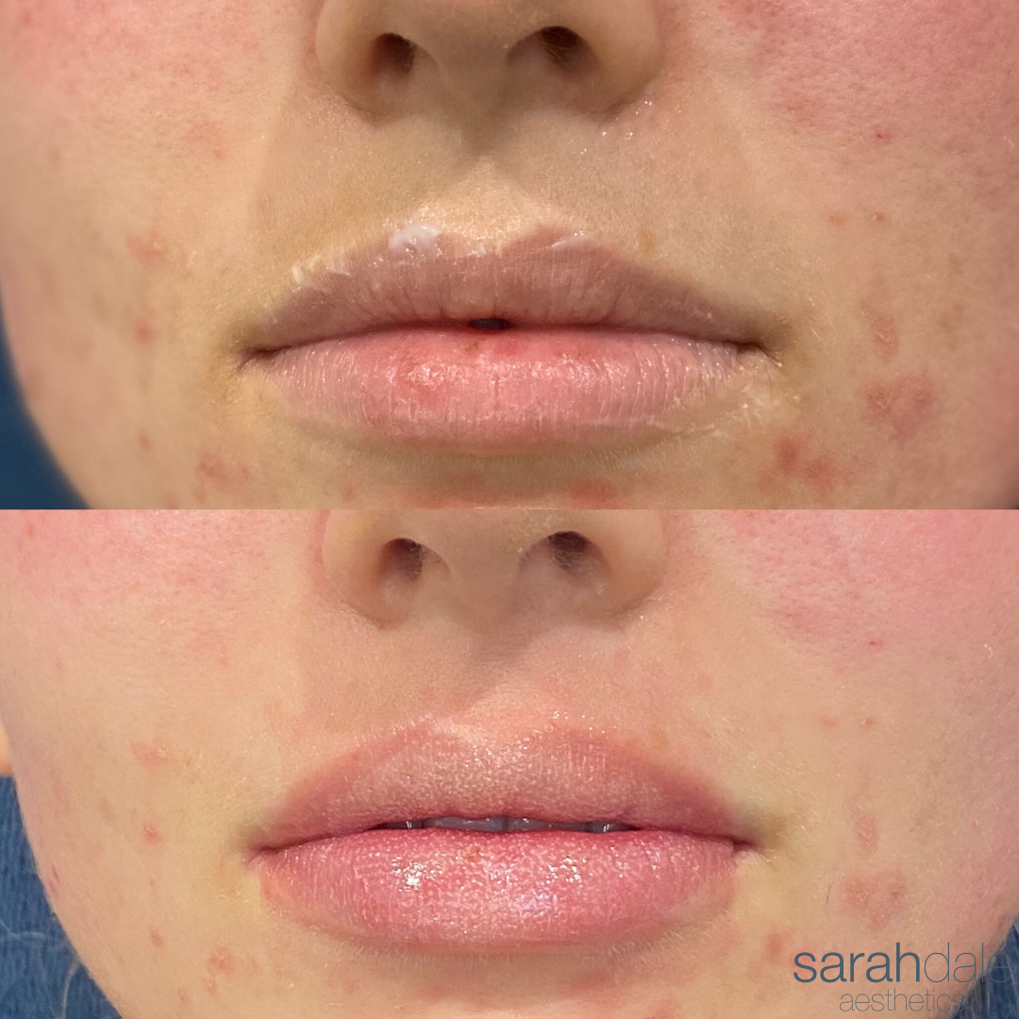 Image 2 from Lets Talk Lips | Sarah Dale Aesthetics